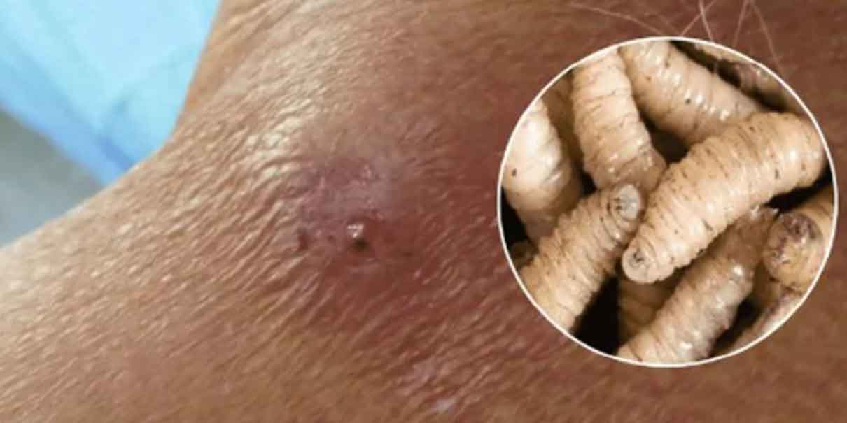 Salud confirma primer caso de miasis en humanos en Chiapas