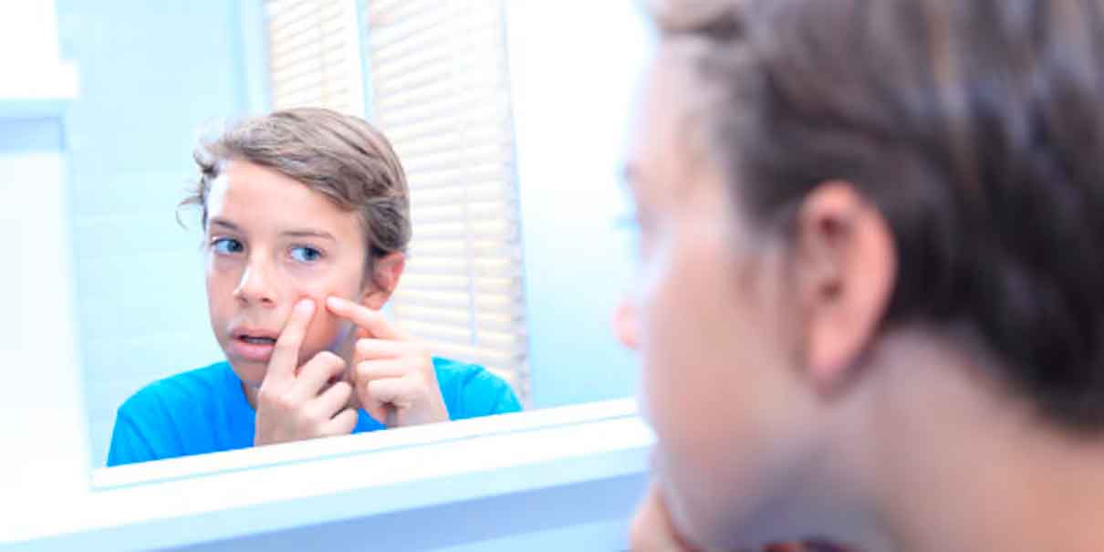 Cómo prevenir el acné durante el calor: guía para cuidar tu piel en climas cálidos