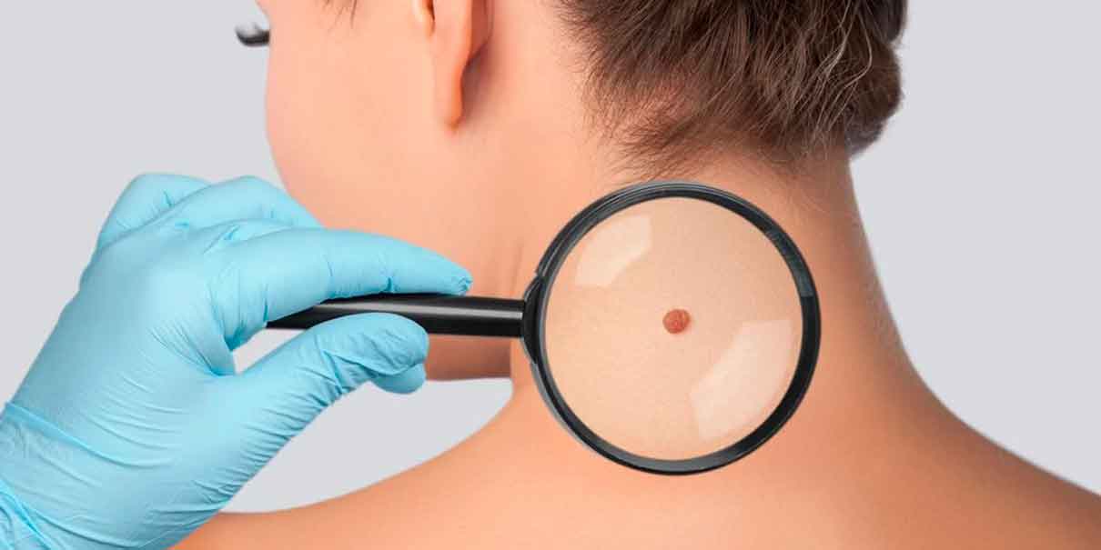 Vitamina B3 podría reducir el riesgo de cáncer de piel hasta en un 54%: Estudio 