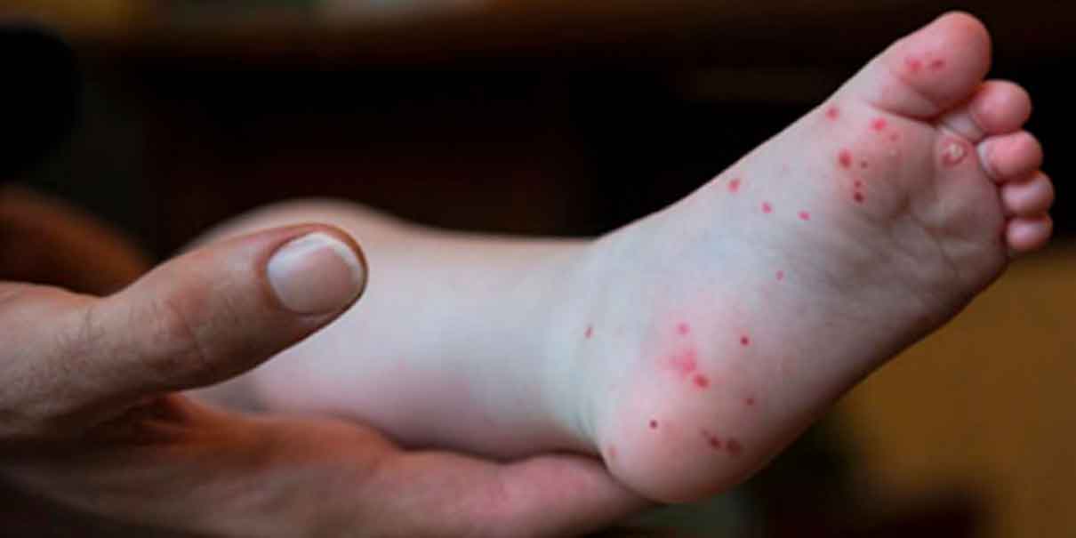 Virus Coxsackie: síntomas, causas, tratamiento y grupos más vulnerables