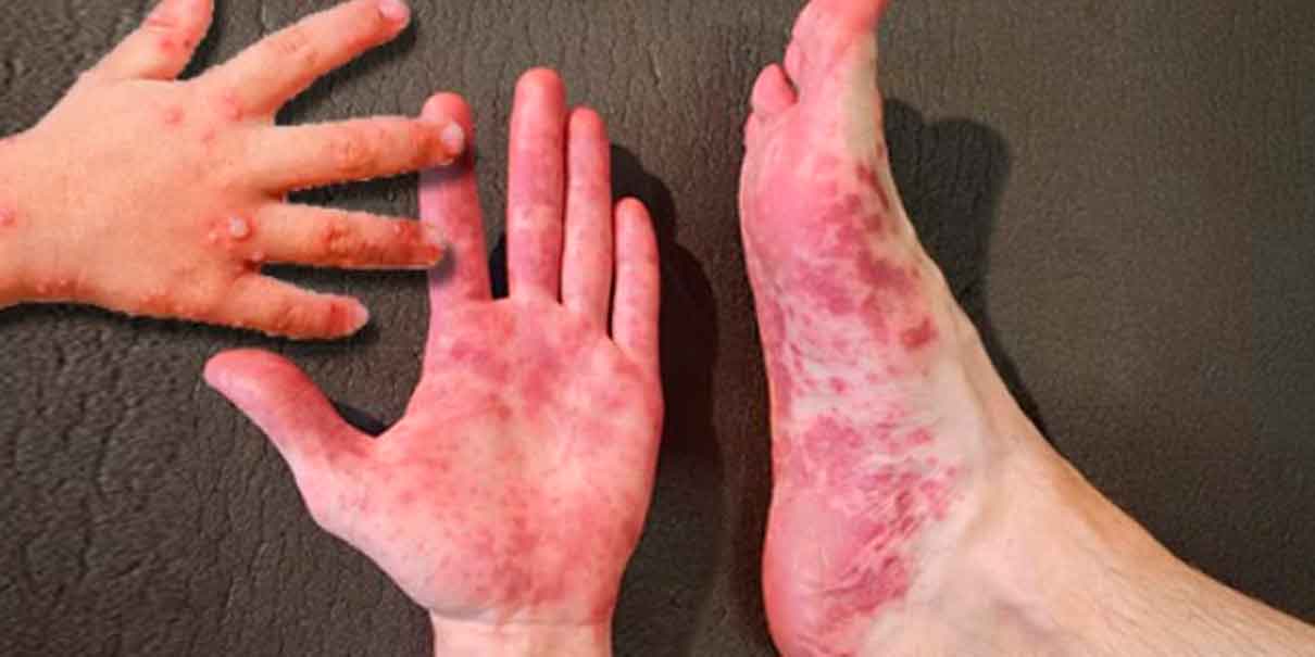 Confirman brote de virus Coxsackie en 77 escuelas de Puebla: 419 alumnos contagiados