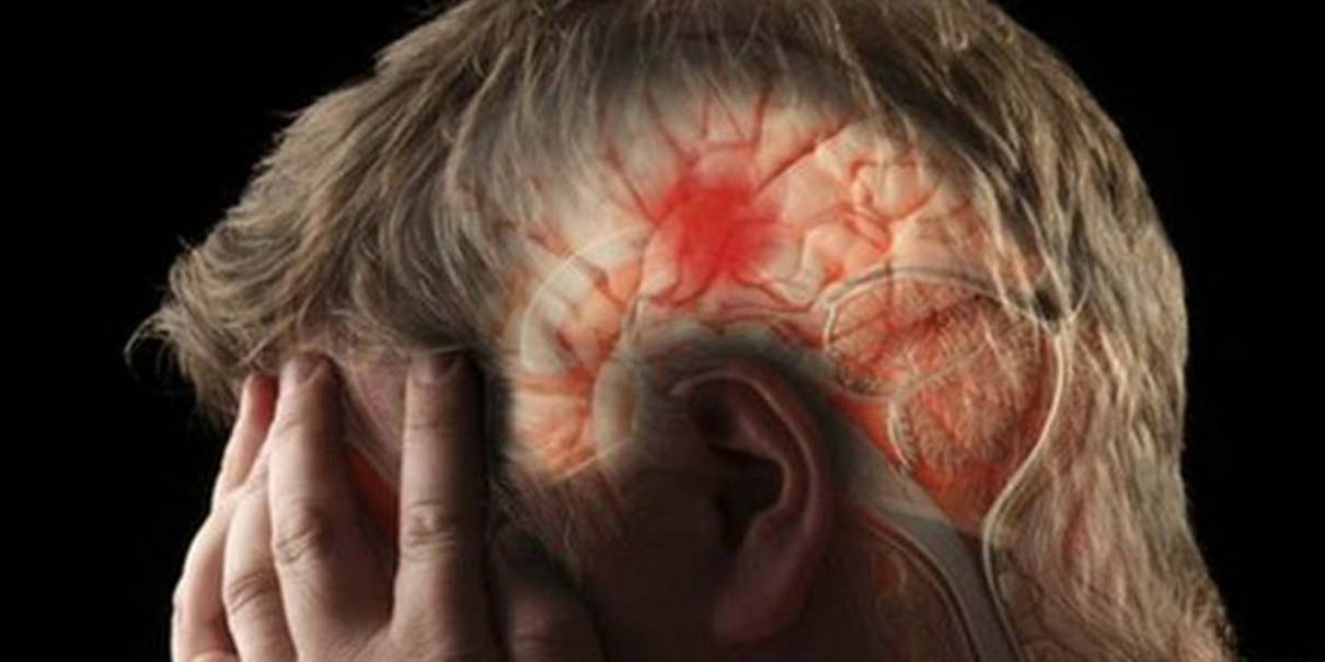 Infarto Cerebral, sólo una atención inmediata te salvará la vida