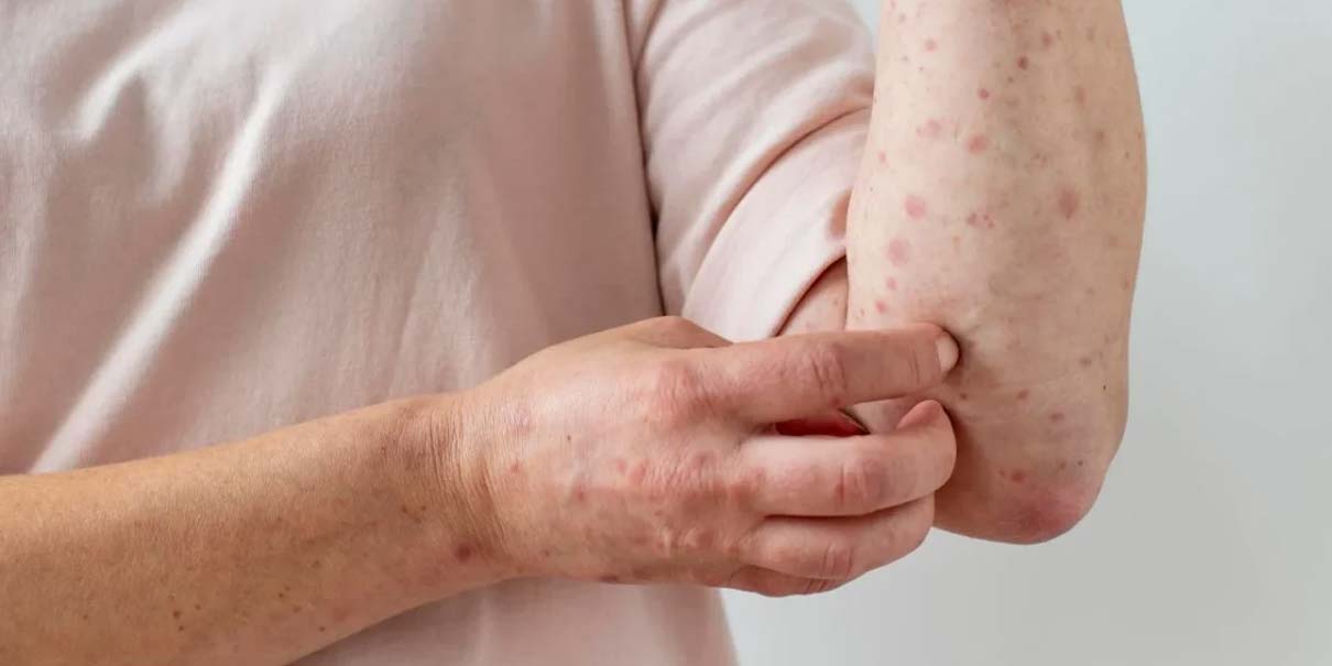 Brote de sarampión llega a los 32 estados de México y suma más de 7 mil casos