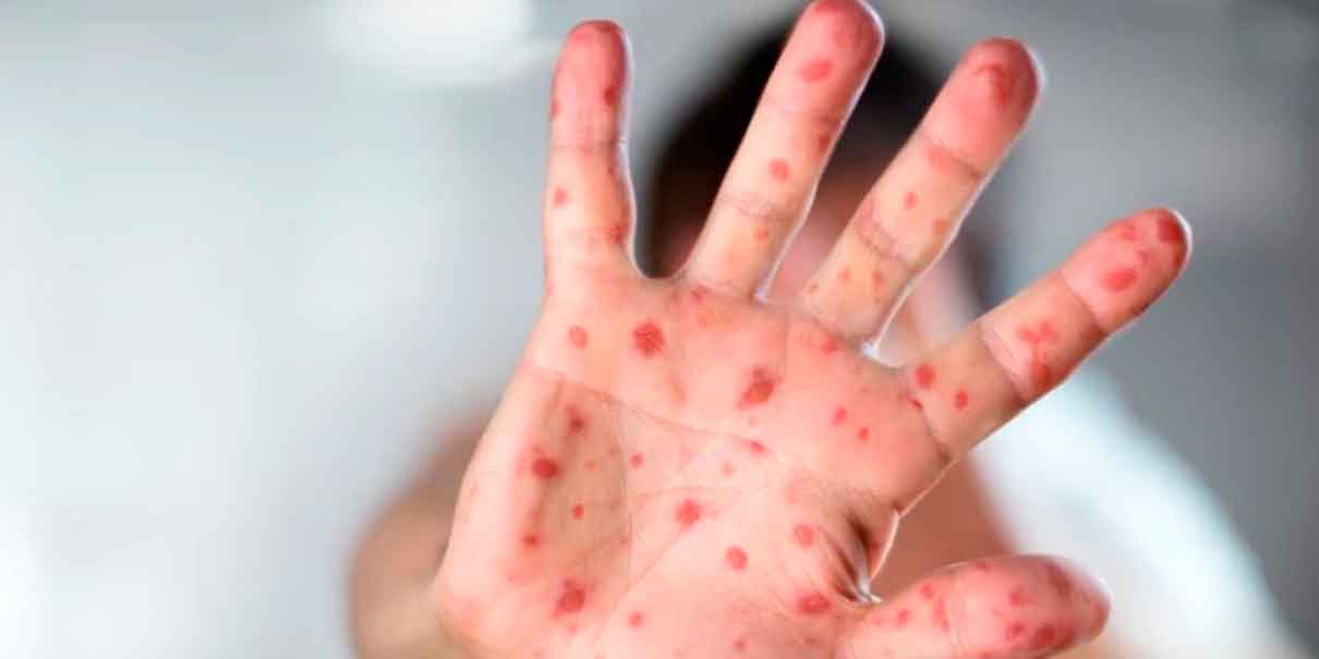 Brote de sarampión en México enciende alertas sanitarias y refuerzan vacunación nacional