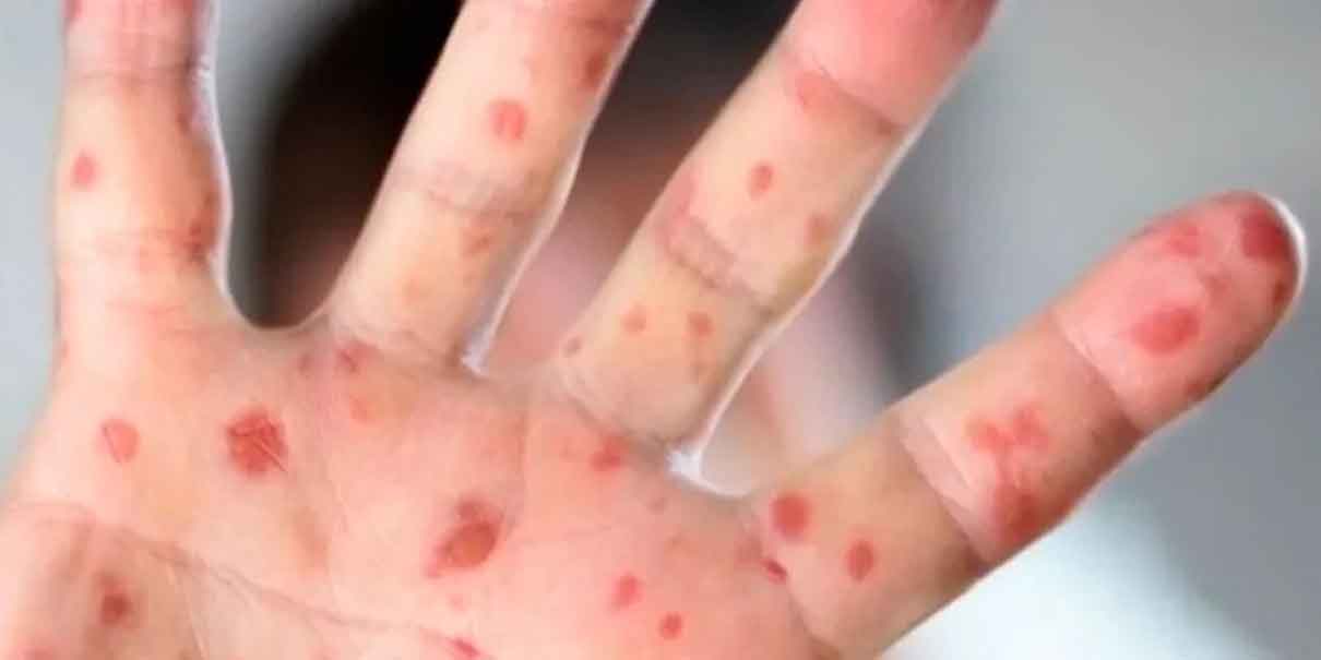 México, primer lugar en casos de sarampión en América, por encima de Canadá y Estados Unidos