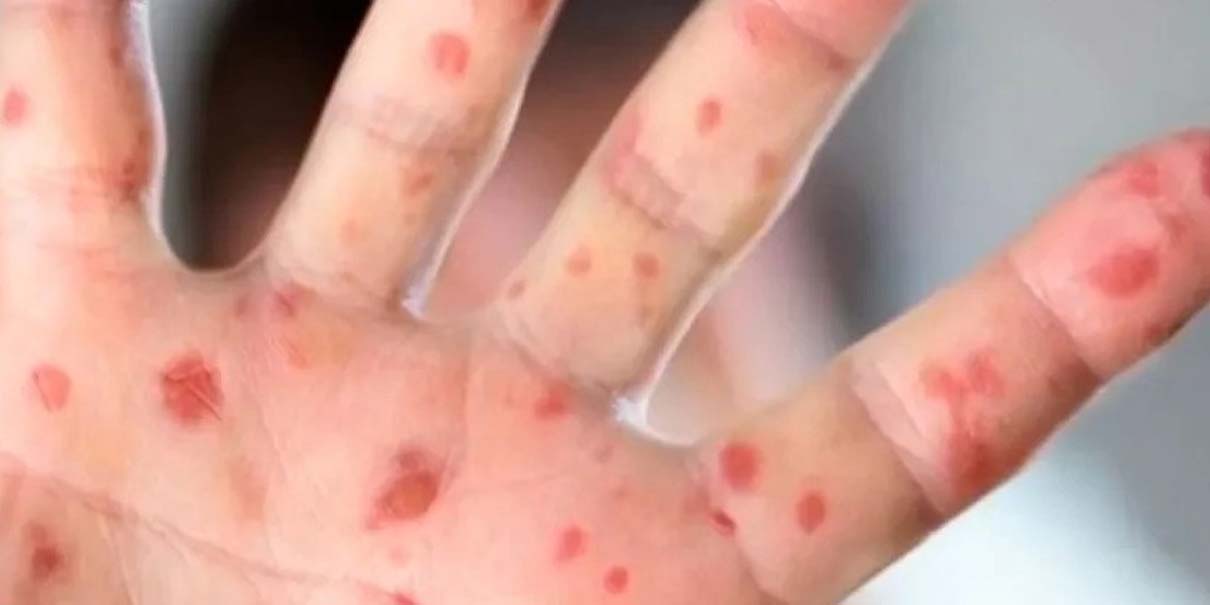 México suma 589 casos de sarampión en solo cuatro días