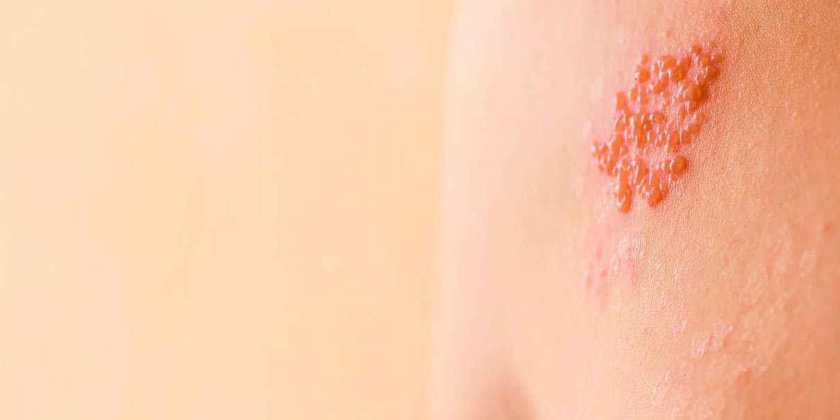 Herpes zóster: el riesgo silencioso que aumenta en personas con enfermedades crónicas