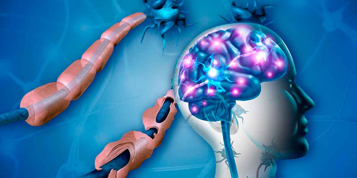 Vitamina D en la esclerosis múltiple