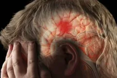 Infarto Cerebral, sólo una atención inmediata te salvará la vida