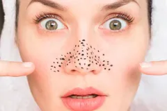 Cómo eliminar los PUNTOS NEGROS: causas, rutina recomendada y productos eficaces 