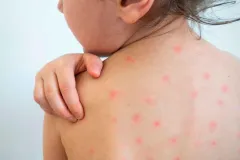 Sarampión en México alcanza nivel histórico en 2025 y alerta a autoridades sanitarias