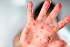 Brote de sarampión en México enciende alertas sanitarias y refuerzan vacunación nacional