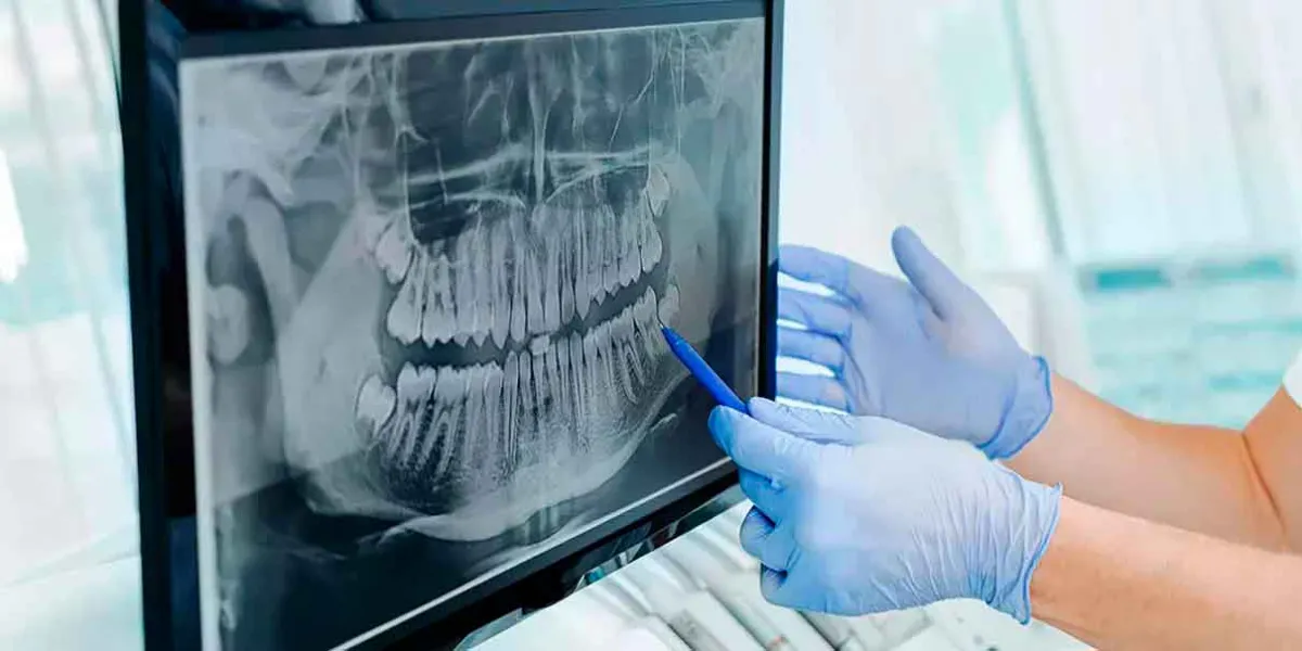 ¿Son seguras las radiografías dentales? Todo lo que necesitas saber