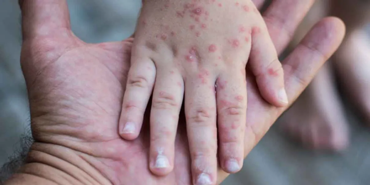 En el país hay 43 casos de sarampión, reporta Salud