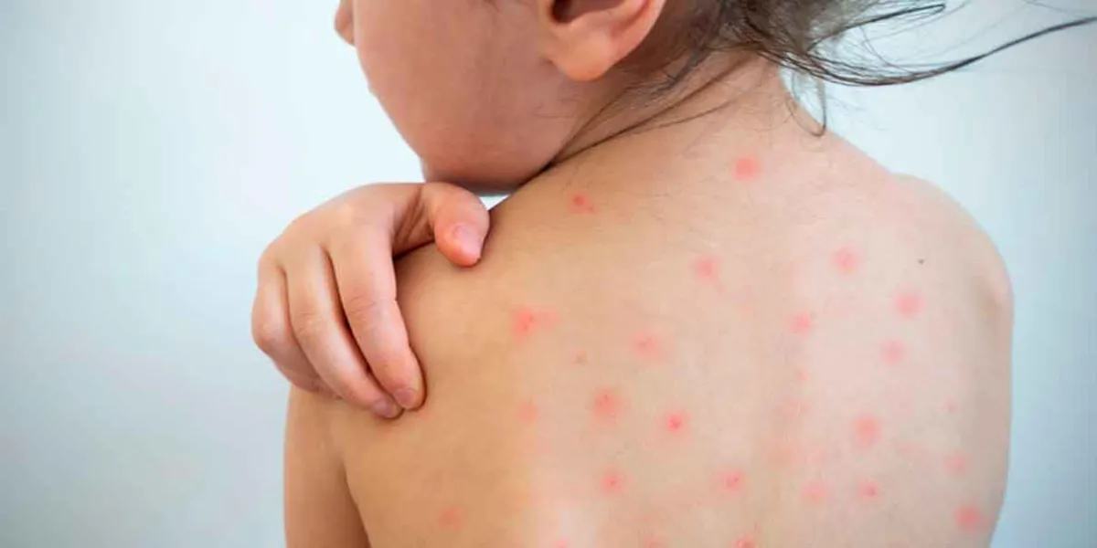 Sarampión en México alcanza nivel histórico en 2025 y alerta a autoridades sanitarias