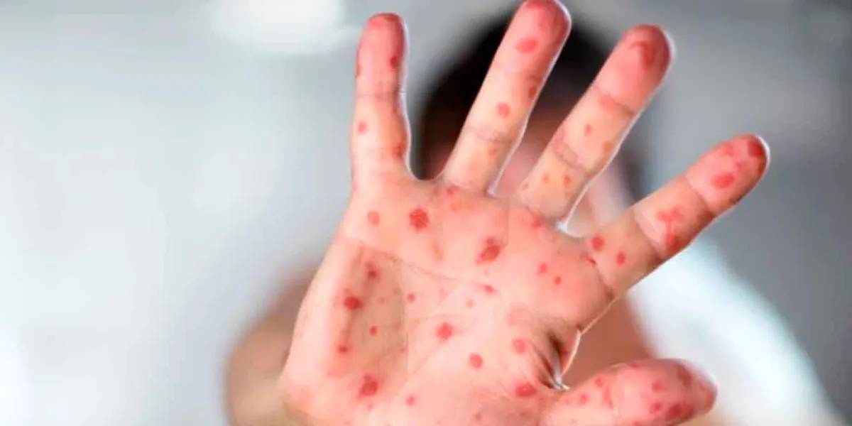 Brote de sarampión en México enciende alertas sanitarias y refuerzan vacunación nacional