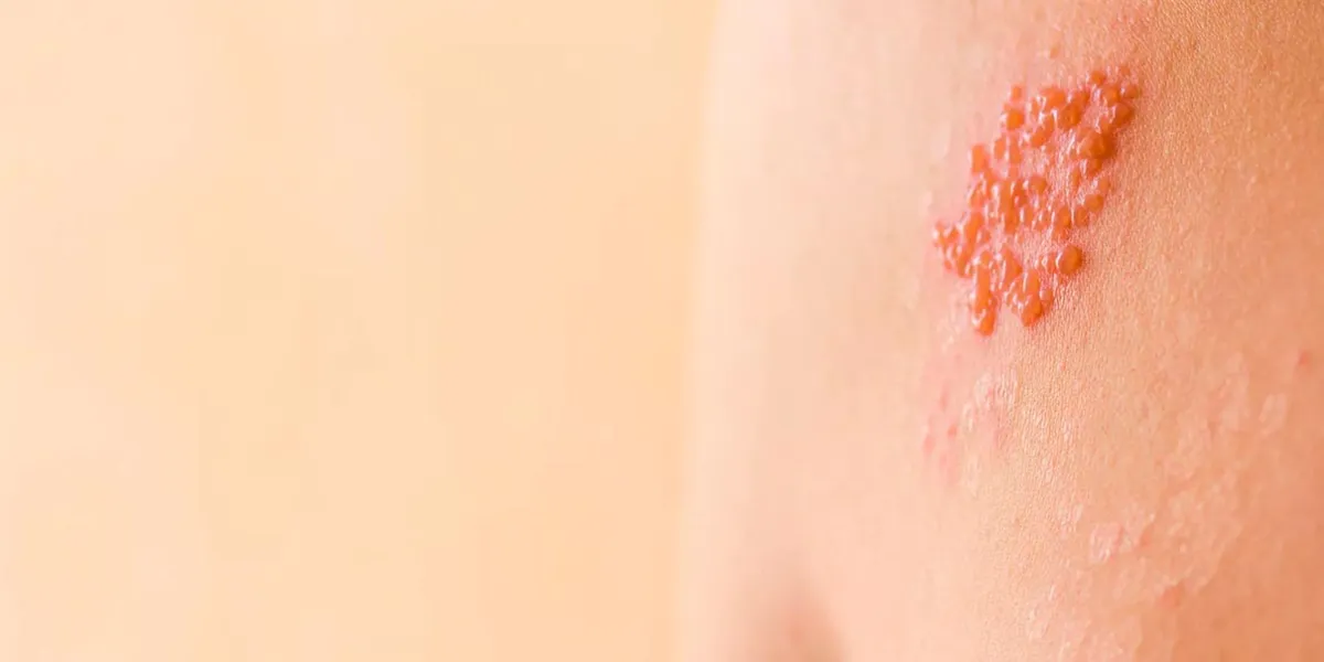 Herpes zóster: el riesgo silencioso que aumenta en personas con enfermedades crónicas