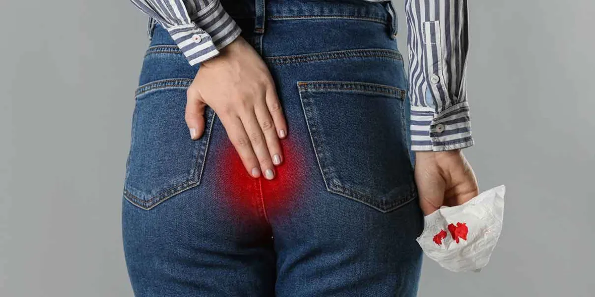 ¿Tienes hemorroides? Señales, causas y hábitos clave para evitarlas