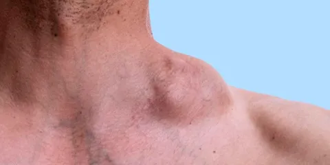 Linfoma en México causas y síntomas de la enfermedad que mató a Memo del Bosque