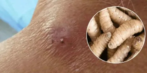 Salud confirma primer caso de miasis en humanos en Chiapas