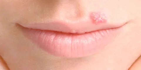 Un virus modificado del herpes podría ser la próxima esperanza contra el cáncer avanzado