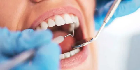 Enfermedades bucodentales: OMS advierte sobre periodontitis y  alternativas con bicarbonato de sodio