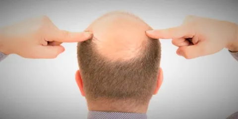 La caída del cabello en hombres: 5 claves para frenar la alopecia y recuperar tu confianza