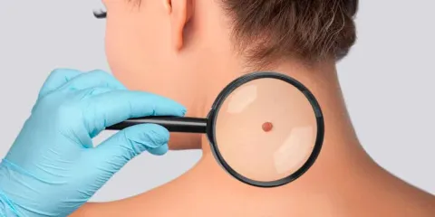 Vitamina B3 podría reducir el riesgo de cáncer de piel hasta en un 54%: Estudio 