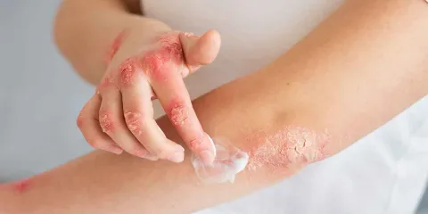 Dermatitis atópica: impacto en la vida diaria y nuevos tratamientos