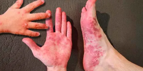 Confirman brote de virus Coxsackie en 77 escuelas de Puebla: 419 alumnos contagiados