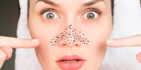 Cómo eliminar los PUNTOS NEGROS: causas, rutina recomendada y productos eficaces 