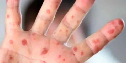 México, primer lugar en casos de sarampión en América, por encima de Canadá y Estados Unidos