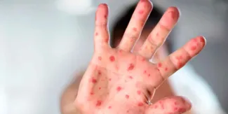 Brote de sarampión en México enciende alertas sanitarias y refuerzan vacunación nacional