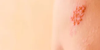 Herpes zóster: el riesgo silencioso que aumenta en personas con enfermedades crónicas
