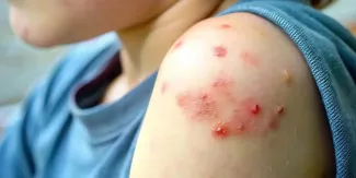 México encabeza crisis de sarampión en América: supera los 14 mil casos