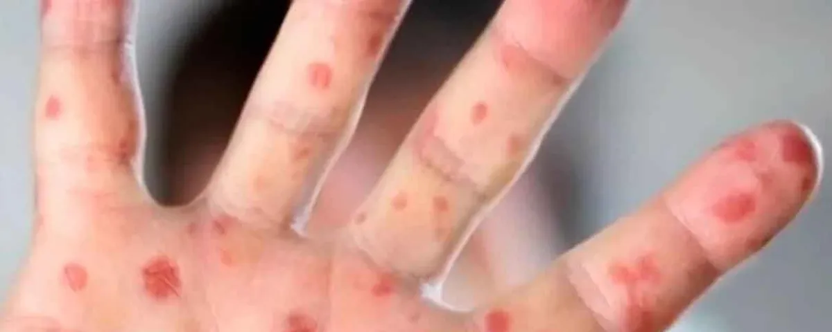 México, primer lugar en casos de sarampión en América, por encima de Canadá y Estados Unidos