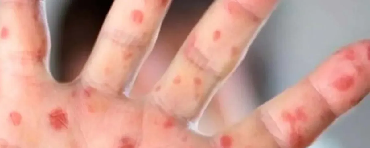 México suma 589 casos de sarampión en solo cuatro días